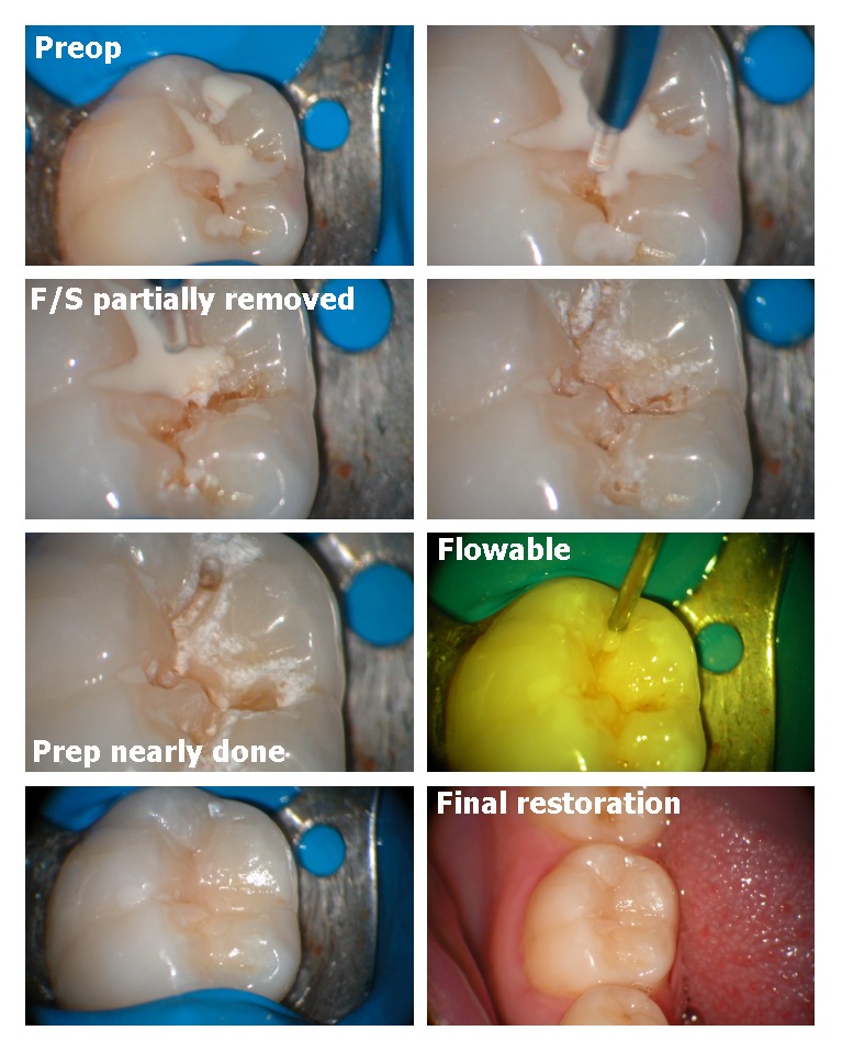 Microdental prep.jpg